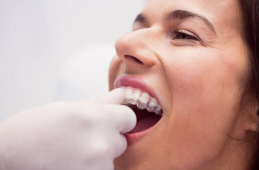 What Should You Know Before Opting for Invisalign Treatment in Langley?
