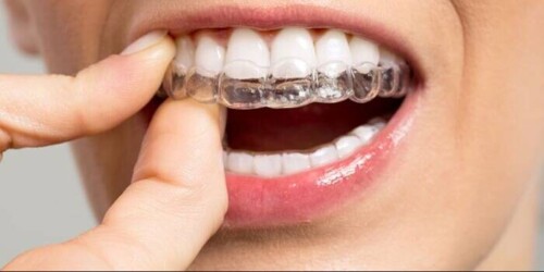 invisaling-t-500x250 Tips To Take Care Of Your Invisalign  